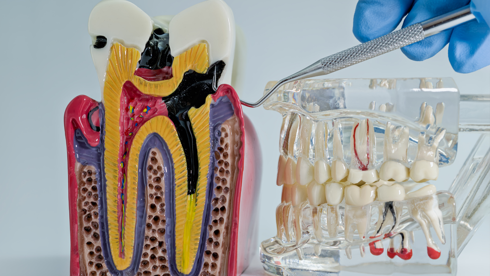 Retratamiento de Conducto